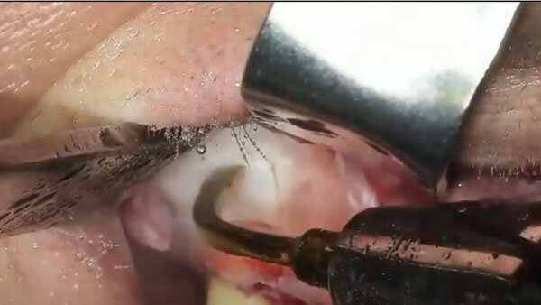 Elevación de seno maxilar con cirugía piezoeléctrica 