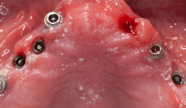 Explantación de implantes maxilares con extractor de implantes y pilares -Dr. Luis Alfonso Rodríguez