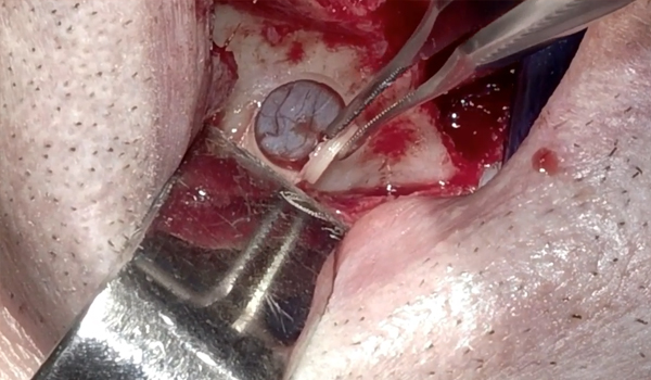 Elevación de seno abierta con kit de elevación lateral con fresas magnéticas Dr. Marcos Terrón