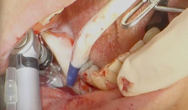 Remoción de Torus con piezo, cirugía guiada y preservación alveolar - Dr. Federico Villarruel