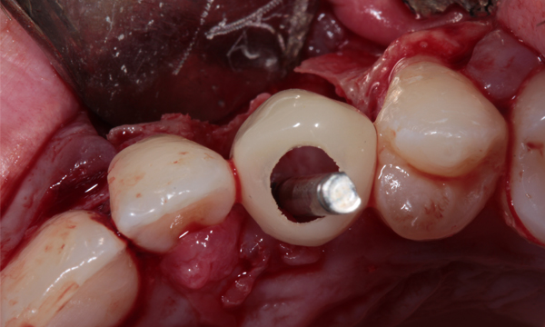 Colocación de implantes simultáneo a la exodoncia, regeneración ósea guiada